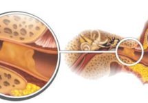 Серная пробка в ухе: симптомы и правильное лечение