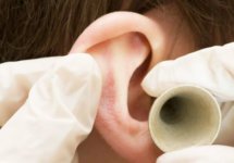 Как вылечить грибок в ушах: основные симптомы и лечение