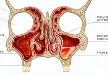 Эффективное лечение гнойного гайморита