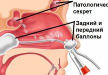 Как проводится ЯМИК-процедура при гайморите?