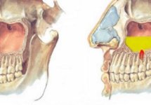Лечение одонтогенного синусита