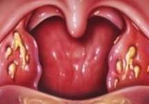 Что такое лакунарная ангина: симптомы и лечение