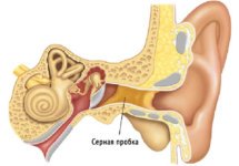 Самостоятельное удаление серной пробки из уха