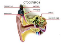 Симптомы и лечение отосклероза уха