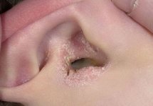 Чем лечить сухие корочки в ушах?
