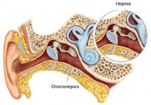 Отосклероз - симптомы и лечение
