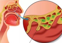 Микозы носа и околоносовых пазух - симптомы и лечение