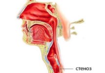 Острый стеноз гортани - симптомы и лечение