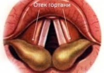 Отек гортани - симптомы и лечение