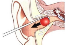 Инородное тело в ухе - первая помощь