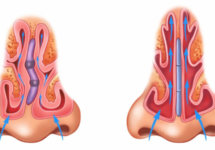 Искривление носа - лечение и операция