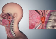 Рак глотки - симптомы и лечение