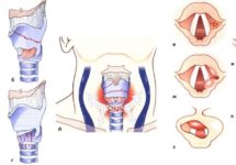Травмы гортани - симптомы и лечение