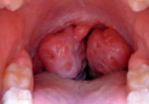 Туберкулез гортани - симптомы, диагностика и лечение