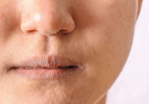Экзема преддверия носа - симптомы и лечение
