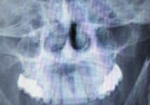 Рентген носоглотки – как делают, что показывает