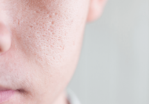 Сикоз преддверия носа: причины, симптомы, лечение